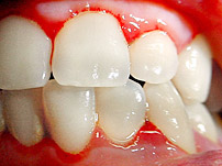 歯周病の場合の写真1