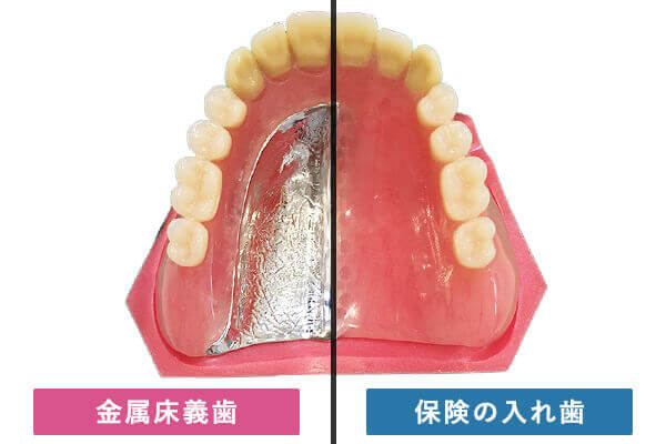 金属床義歯と保険の入れ歯