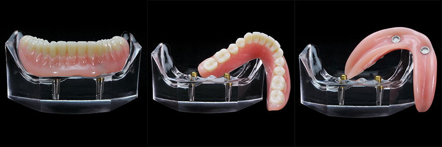 ロケーター義歯模型