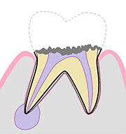 臼歯部の虫歯（C4）の断面