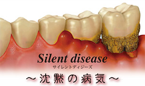 歯周病は沈黙の病気