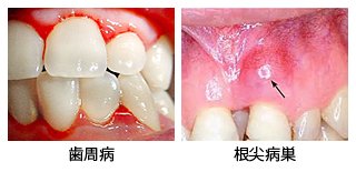 歯周病と根尖病巣